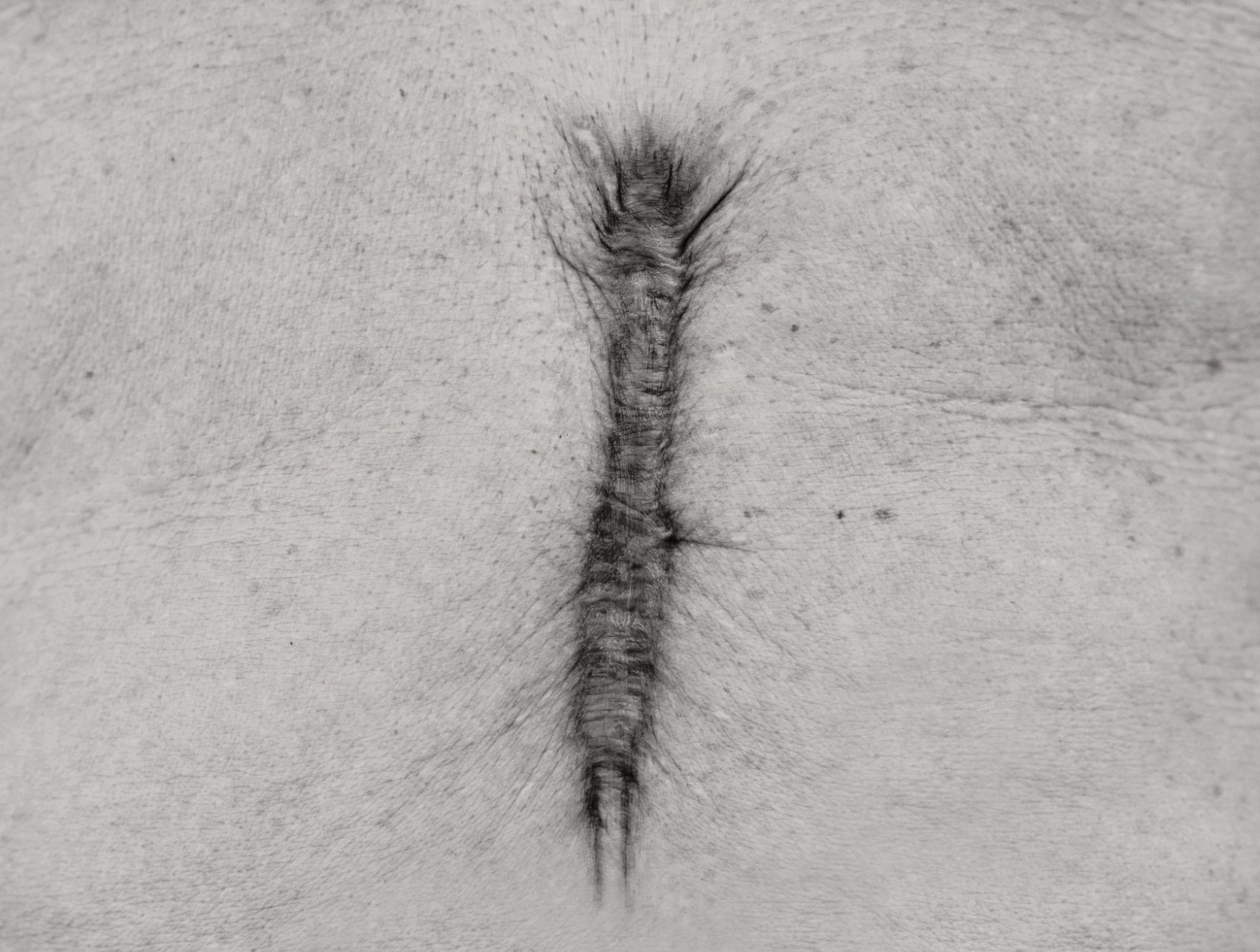 Image of a keloid scar 